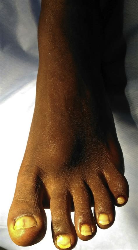 Unusual Presentation Of Foreign Body Granuloma Of The Foot After Sharp