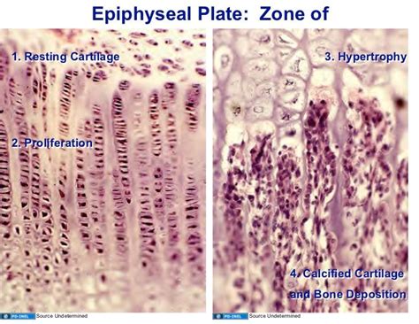 10.13.08: Histology - Bone Formation and Remodeling | Epiphyseal plate