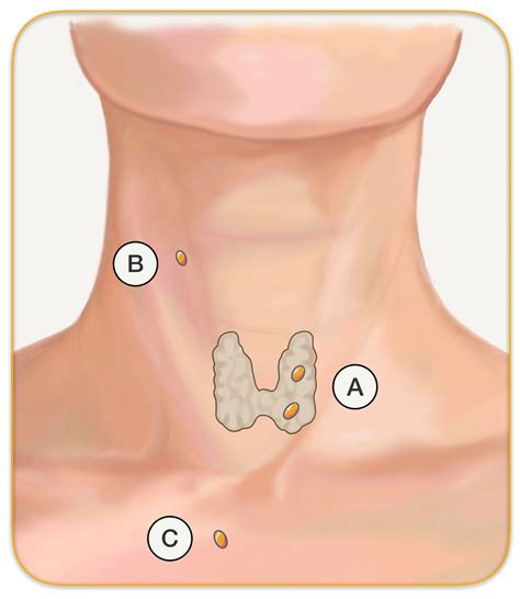 Parathyroid Glands In Throat And Neck Hyperparathyroidism Surgery