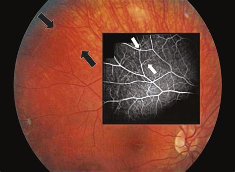 Right Fundus Of The Patient Showing 2 Lacquer Cracks Temporal To The