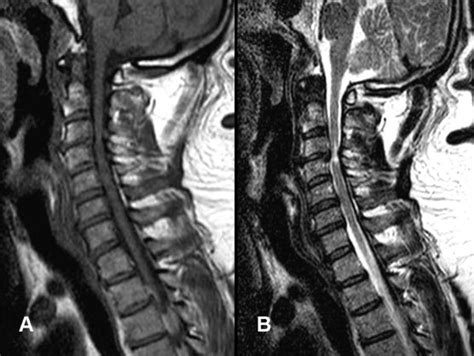 Magnetic Resonance Imaging Mri Of The Cervical Spine Shows Cervical