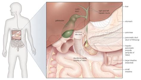 Understanding Gallstones And Gallbladder Disease