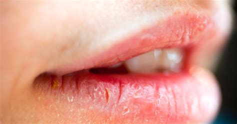 Rissige Lippen Symptome Ursachen Behandlungen