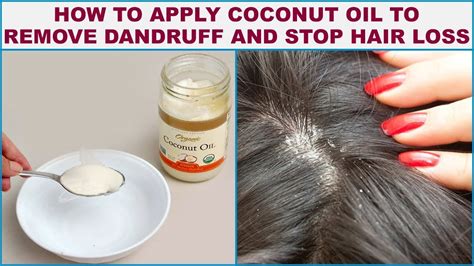 How To Use Coconut Oil For Dandruff 3 Effective Ways To Fight