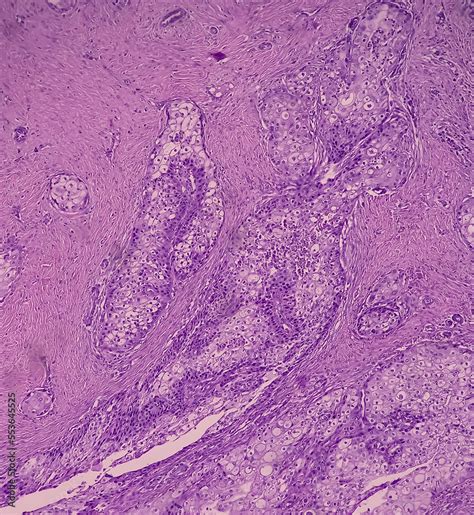 High Grade Mucoepidermoid Carcinoma Of Parotid Cyst Microscopic Show