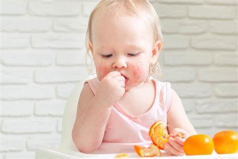 Alergia Pokarmowa U Dzieci Jedna Z Najcz Ciej Nadrozpoznawalnych Chor B Dzieci Cych Jamama Pl