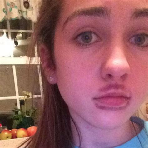 The Stupidest Trend Of The Moment Kylie Jenners Lip Challenge And Fuller Lips Everything Mixed