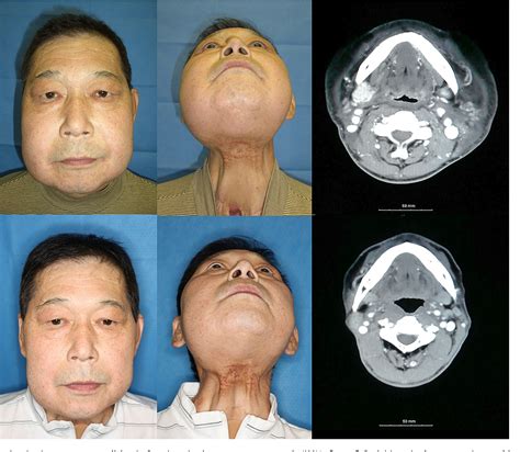 Figure 1 From Lymphaticovenous Anastomosis For Facial Lymphoedema After