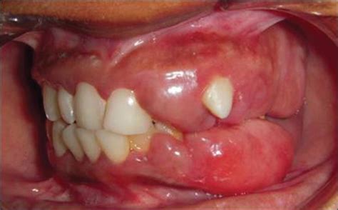 Swollen Gums Or Gingivitis Commonly Occurs Because A Film Of Plaque