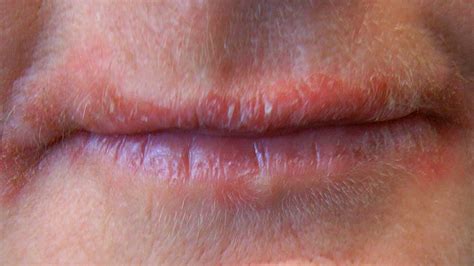 Due Settimane Footpad Teorico Tiny Bumps On Lips Scelta Codice Lama