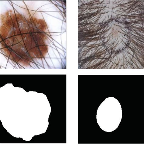 Some Examples Of Skin Lesion Images In The Isic 2017 Dataset The First
