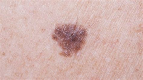 Arm Mole Count Predicts Skin Cancer Risk Bbc News