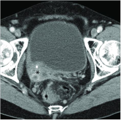 Cervical Carcinoma With Bladder Wall Invasion Axial Contrast Enhanced