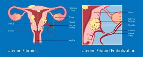 Uterine Fibroid Embolization St Louis Mo And Evergreen Park Il