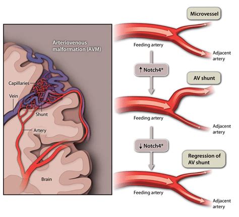 Arteriovenous Malformations In Five Dimensions Science Translational