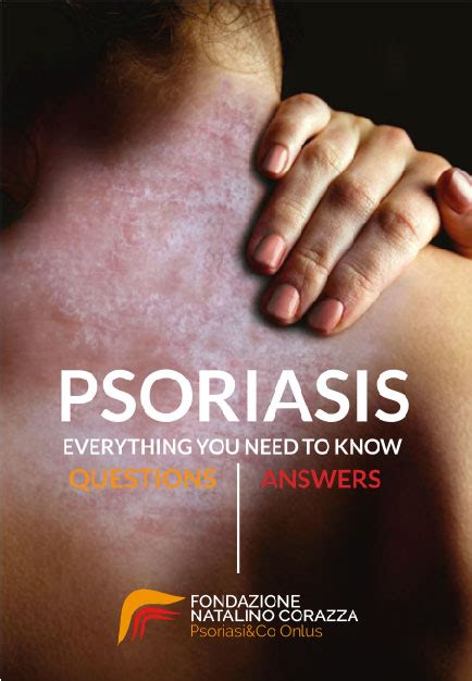 E Book Psoriasis A Well Thought Out Guide With Questions And Answers