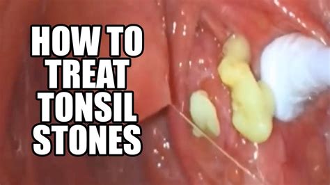 Tonsil Stones How To Treat And Remove Youtube
