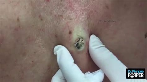 Dr Pimple Popper See This Giant Blackhead Get Squeezed Leaving A