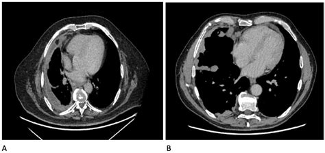 Mesothelioma Vs Pleural Metastasis Radiology Diagnostics Free Full