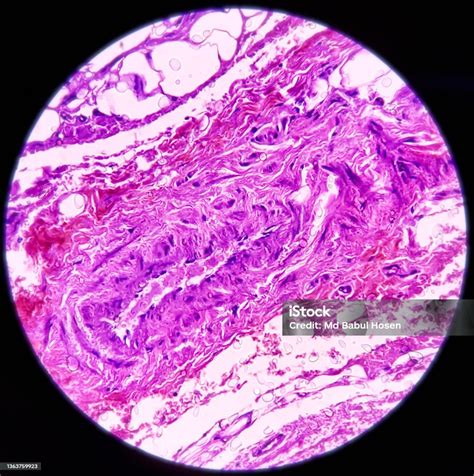 Chest Wall Cyst Epidermal Inclusion Cyst Commonly Called Sebaceous Cyst