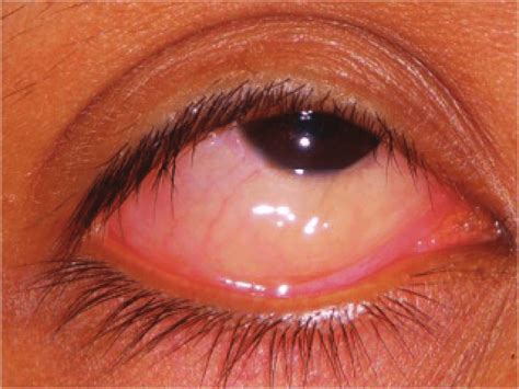 Chemosis Involving The Bulbar Conjunctiva In Mild Allergic