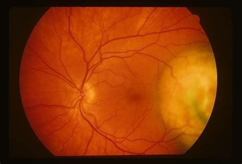 Choroidal Melanoma Retina Image Bank