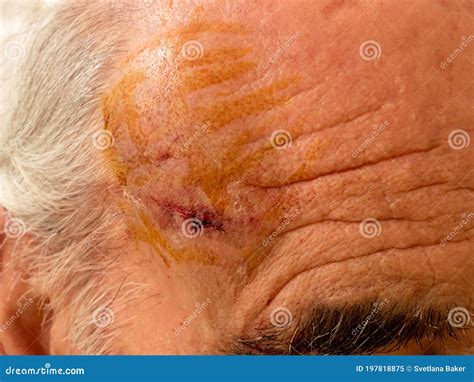 Selective Focus On Painful Red Swollen Forehead Injury Older Bold Man
