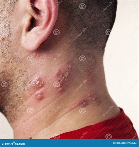 Raised Red Bumps And Blisters Caused By The Shingles Virus Royalty Free