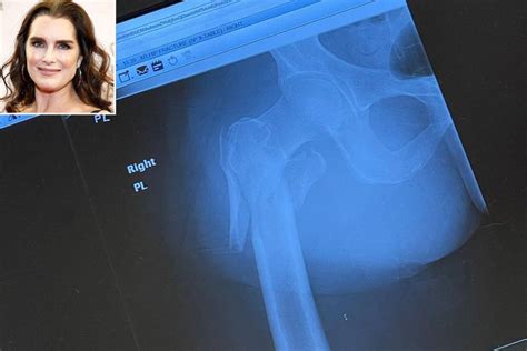 Brooke Shields Shares X Ray Of Her Broken Femur