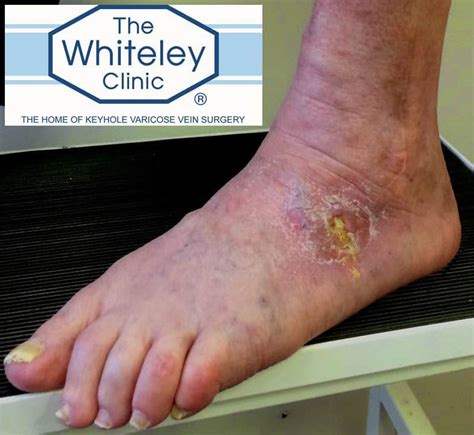 Venous Foot Ulcer Cured By The Whiteley Protocol