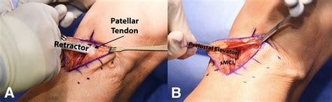 Medial Opening Wedge Proximal Tibial Osteotomy Arthroscopy Techniques