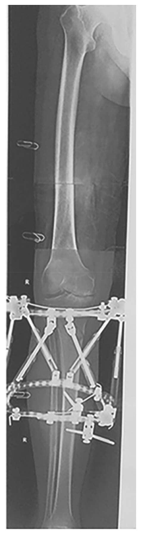 A 53 Year Old Male Suffered With Knee Osteoarthritis Combined With