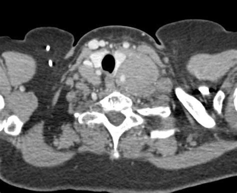 Lymphoma With Massive Neck Adenopathy Neuro Case Studies Ctisus Ct