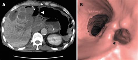 Perforation Of The Colon By Invading Recurrent Gastrointestinal Stromal