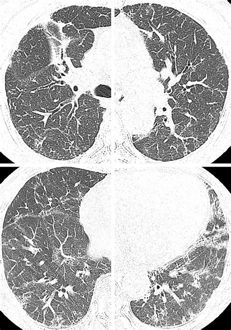 Figure1a Chest Computed Tomography Scan Showed A Reticular Shadow And