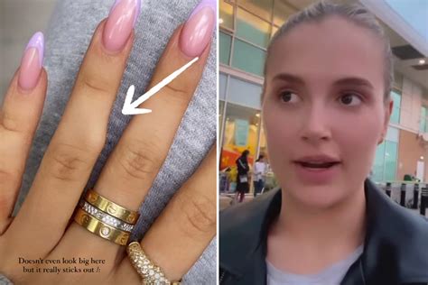 Molly Mae Hague Reveals Rock Hard Big Lump On Her Finger As She Asks
