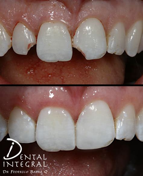 Resinas Dentales Queretaro Dental Integral Baena