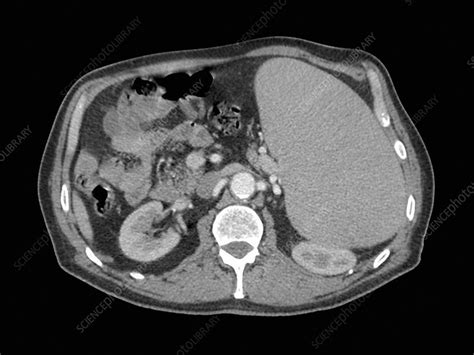 Splenomegaly Ct Scan Stock Image C0213049 Science Photo Library