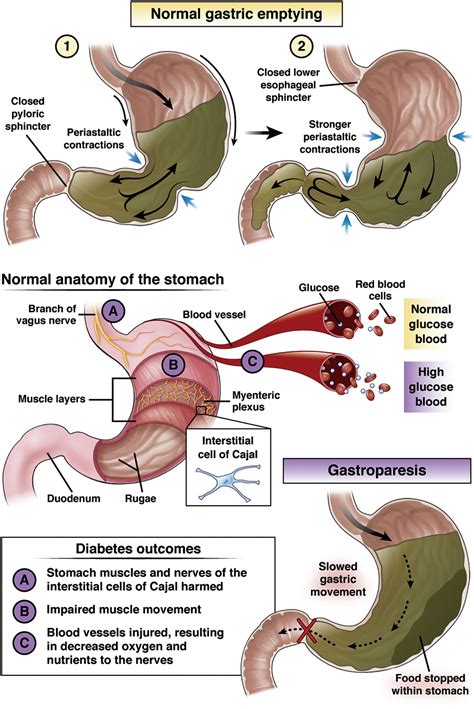 Diabetic Gastroparesis Clinical Gastroenterology And Hepatology