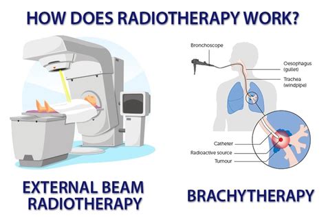 External Radiation Therapy All About Radiation