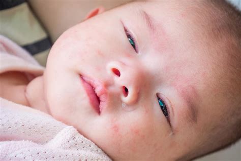 Itchy Bumps On Babys Face