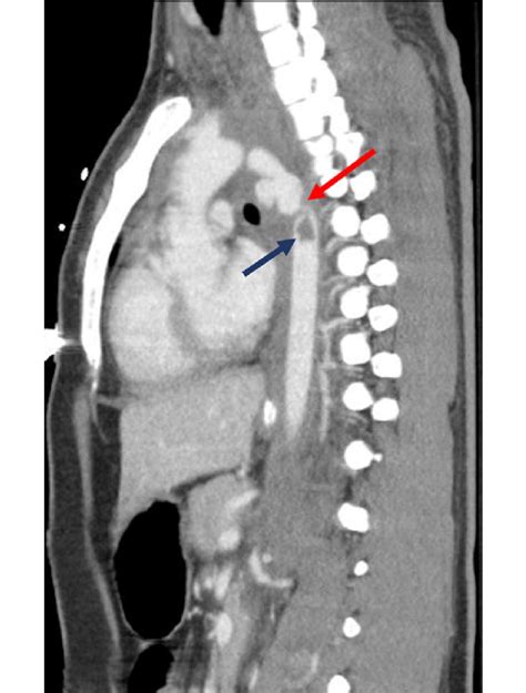 Ct Scan Image Demonstrating Aortic Transection Near The Isthmus Red