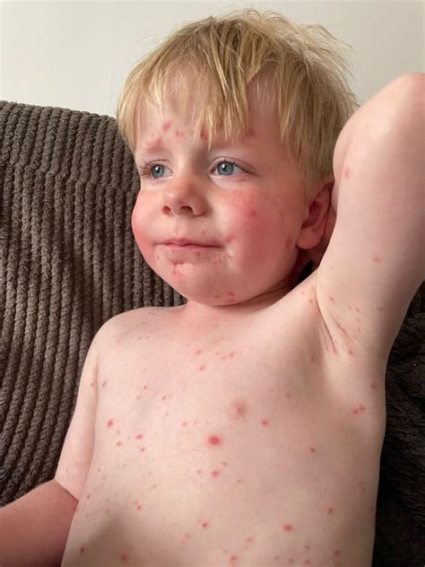 My Children Were So Poorly With Chickenpox The Vaccine Should Be