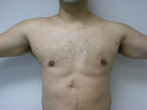 Gynecomastia Before And After Pictures Miami Aventura Fl