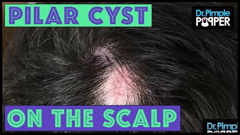 Multiple Pilar Cysts On Scalp Pilar Cyst Of The Scalp Open I I Will