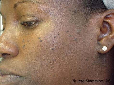 Black Spots On Skin Face And Body Causes And Treatmen