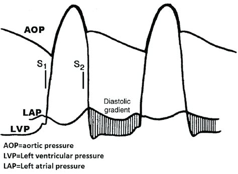 Physiopathology Of Mitral Stenosis Demonstrating The Diastolic