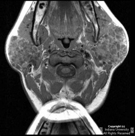 Neuroradiology On The Net Bilateral Parotid Gland Malt Lymphoma In A