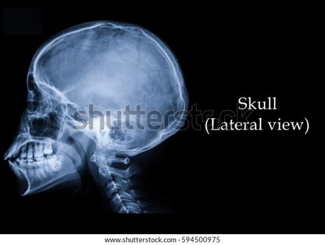 Film Xray Skull Lateral View Show Stock Photo Edit Now 594500975