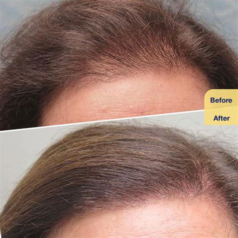 Reginera Hair Treatment | Hair Fall Treatments Kuwait